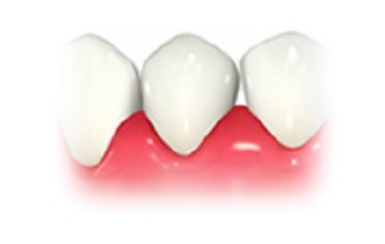 歯肉が腫れている