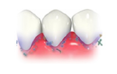 歯肉がむずがゆい