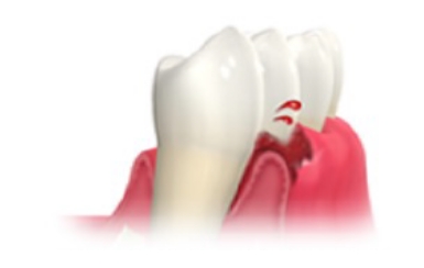 歯ぐきから出血する