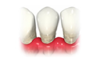 歯がグラグラする